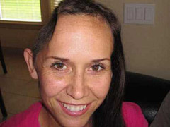 Sau tai nạn, hoa hậu ‘nuôi dưỡng’ 1/4 hộp sọ trong bụng