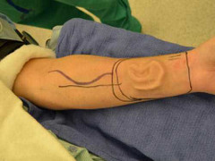 Kì diệu vành tai ‘mọc’ trên cánh tay