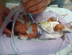 Cặp bé gái sinh đôi bé nhất nước Anh sống sót kỳ diệu