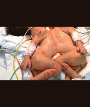 TP.HCM:Thêm một cặp song sinh dính liền cực kì phức tạp