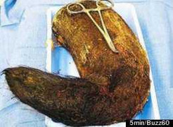 Nữ sinh 19 tuổi nhập viện vì ăn gần 2 kg tóc và phấn