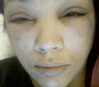 Hậu nhuộm tóc: Mắt sưng, đầu muốn nổ tung