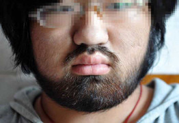 Cô gái 16 tuổi bỗng mọc lông tóc như đàn ông