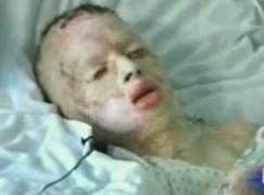 Bỏng 99% không chết, chết vì ung thư vết bỏng