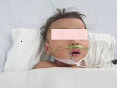 Loét tá tràng, bé trên 14 tháng bị xuất huyết nặng