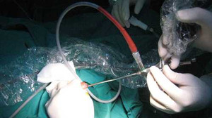 Bé 9 tuổi bị sỏi kẹt ở bàng quang