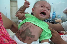 Một phụ nữ, 3 trẻ nhỏ bị tạt axit dã man