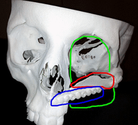 Ung thư dạng hiếm,trải qua 10 ca phẫu thuật tái tạo mặt