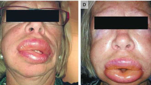 Người phụ nữ có khuôn mặt bị sưng húp