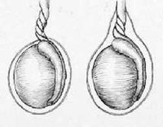 Chẩn đoán nhầm bệnh, thiếu niên bị cắt tinh hoàn