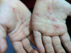 Phụ huynh 'tố' cô giáo dùng vật nhọn đâm tay con