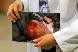 Bà già 60 tuổi sở hữu buồng trứng nặng 28kg