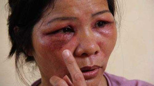 Những vết rộp do kiến ba khoang tấn công