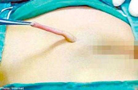 Phẫu thuật cắt 'đuôi' 6 cm cho bé gái