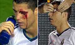 Đối phương chơi xấu, Ronaldo máu chảy đầm đìa