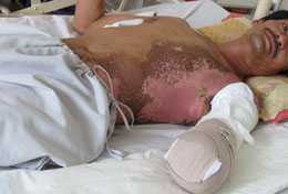 Bị điện giật khi sửa mái nhà, mất nửa cánh tay