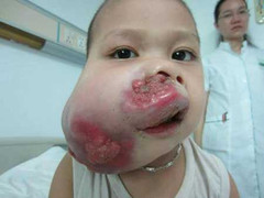 Xót xa gia cảnh bé trai bị ung thư biến dạng mặt
