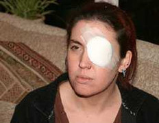 “Nổ” mắt lần thứ 2- người phụ nữ đối diện nguy cơ bị mù