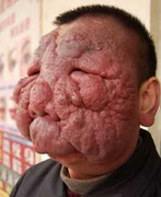 Người đàn ông bị khối u 'bò' kín mặt