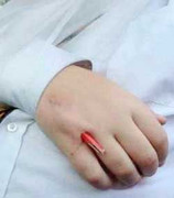 Bút chì cắm sâu vào tay, bé vẫn bị từ chối phẫu thuật