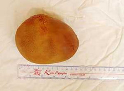 Viên sỏi bàng quang nặng 0,8kg