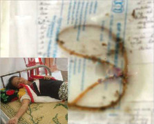 Ống thông tiểu 25cm để quên trong ‘vùng kín’ hơn 2 năm