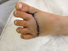 Đi qua pô xe máy, bé gái gần đứt lìa bàn chân