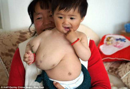 Mang khối u khổng lồ, bé 1 tuổi vật lộn tập đi