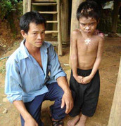 Độc giả tiếp tục ủng hộ bệnh nhân Mường Chiềng