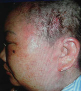 Lở loét, sưng vù sau khi nhuộm tóc