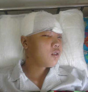 Cứu sống bệnh nhân dập não vì tai nạn giao thông