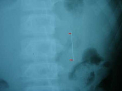 10 ngày theo dõi chiếc kim dài 6cm trong dạ dày