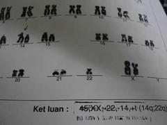 Sảy thai liên tục do nhiễm sắc thể trục trặc