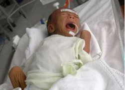 Bị mẹ cắn đứt ngón tay, bé sơ sinh nguy kịch