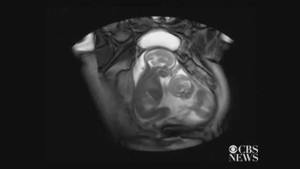 Clip: Thai song sinh 'đá nhau' trong bụng mẹ