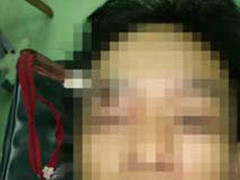 Hi hữu: Tự đâm kéo vào mắt mình