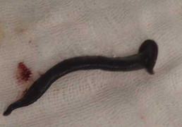 Hà Tĩnh: Phát hiện đỉa ký sinh trong thanh quản người