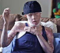 Bỏng dung dịch kiềm, người phụ nữ biến thành 'quỷ'