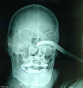 Trượt chân ngã, móc sắt khổng lồ chọc vào mắt