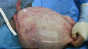 Khối u trong bụng, bé gái 12 tuổi bị 'kết tội' có thai