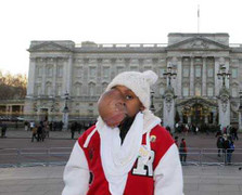 Đáng thương bé gái với khối u khổng lồ trên mặt