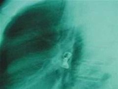 Nuốt bóng đèn, một bé 13 tháng tuổi suýt chết