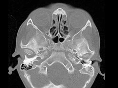 Răng kẹt trong tai suốt 3 năm liền