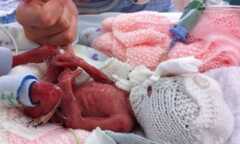 Chiếc kéo vô tình cứu sống bé sinh non
