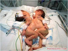 Video: Phẫu thuật tách cặp song sinh dính liền ở TP.HCM