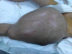 Mổ u quái 12,5kg cho người nước ngoài