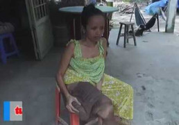 Nghệ An: Nặng 30kg mang trên mình bướu 10kg