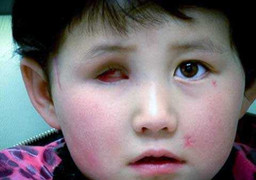 Bị bắn vào mặt, bé gái 6 tuổi may mắn sống sót