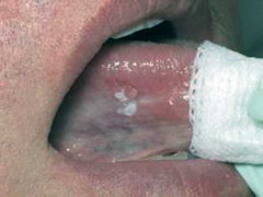 Bệnh nhân ung thư miệng bị quán ăn ngược đãi