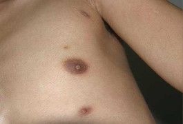 Kỳ lạ chàng trai mọc tới... 7 núm vú